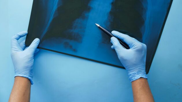 Sokakat fenyeget, kevesen tudnak erről a tüdőbetegségről