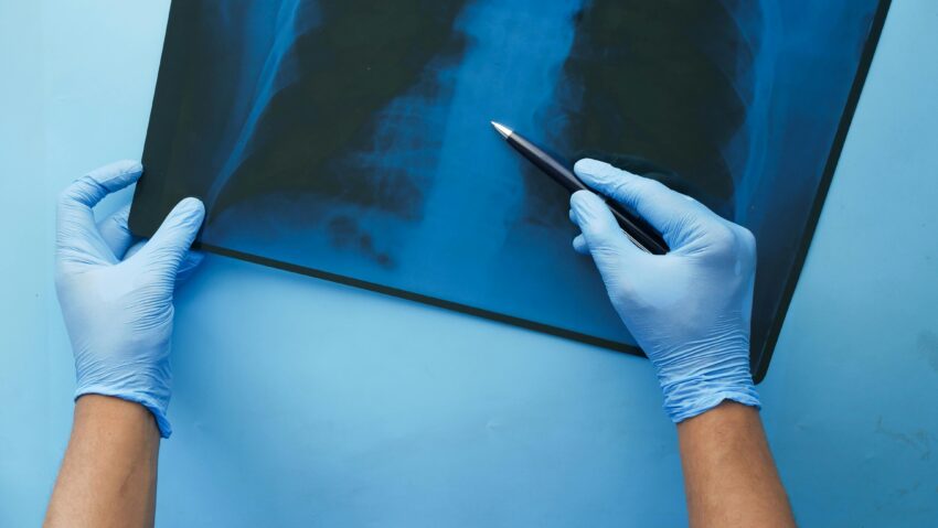 Sokakat fenyeget, kevesen tudnak erről a tüdőbetegségről