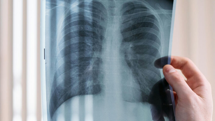 Miért sok még mindig nálunk a tbc-s beteg?